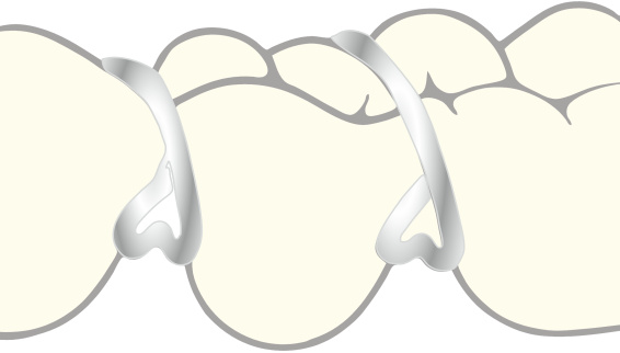 Triangle clasp, illustration in situ, dental arch, orthodontics, catalogue