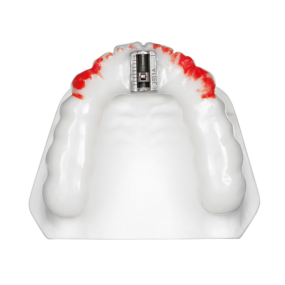 TAP®-T, vampire, upper jaw, application example, online gallery