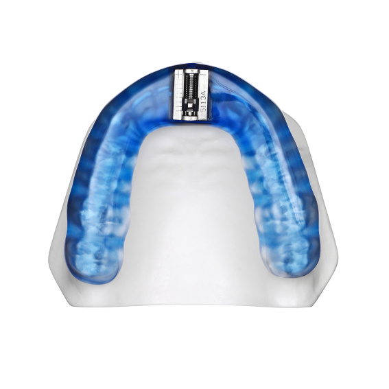 TAP®-T Reverse neon blue, upper jaw, application example, online gallery