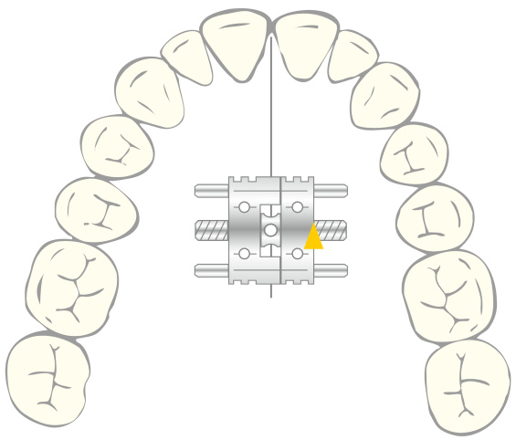 VECTOR® 190, VECTOR® 200, illustration in situ, dental arch, orthodontics, catalogue