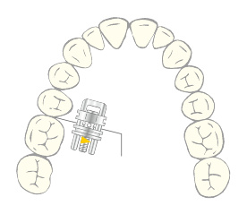 VECTOR® 420, illustration in situ, dental arch, orthodontics, catalogue