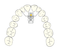 VECTOR® 440 R, illustration in situ, dental arch, orthodontics, catalogue