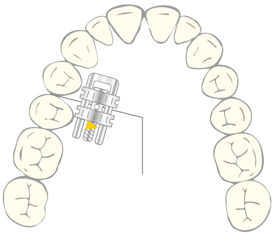 VECTOR® 460, illustration in situ, dental arch, orthodontics, catalogue