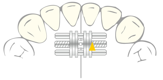 VECTOR® 90, VECTOR® 100, illustration in situ, dental arch, orthodontics, catalogue